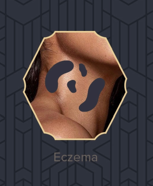 Beauty IQ Pro Spa Skincare Eczema | Ask The Esthetician