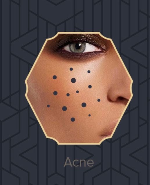 Beauty IQ Pro Skincare Acne Ask The Esthetician