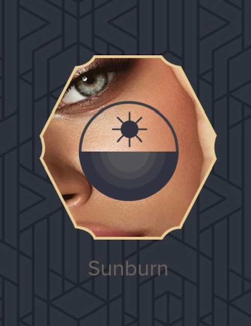 Beauty IQ Pro Spa Skincare Sunburn | Ask The Esthetician